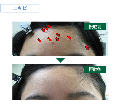 肌理の悪化抑制傾向